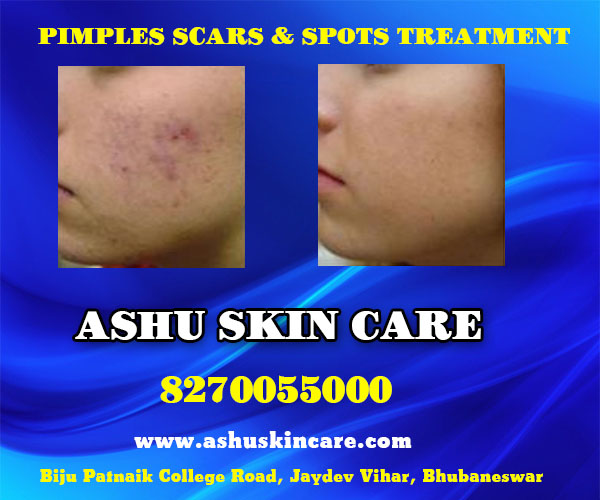 best pimples and spots treatment clinic in bhubaneswar near ayush hospital